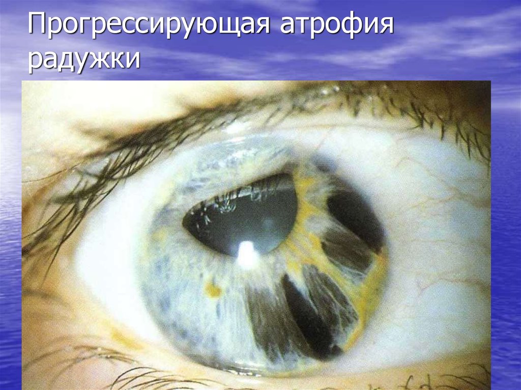 Прогрессирующая атрофия радужки