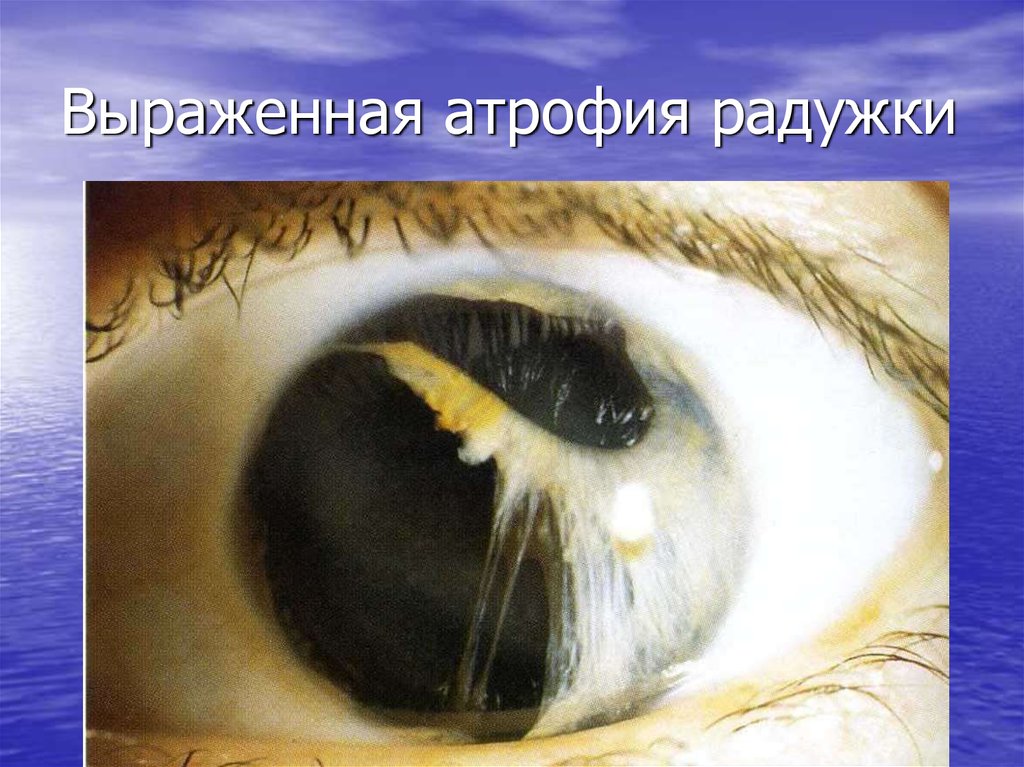Выраженная атрофия радужки