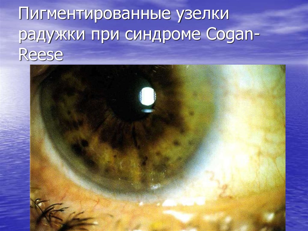 Пигментированные узелки радужки при синдроме Cogan-Reese