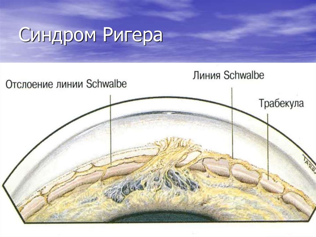 Синдром ригера фото