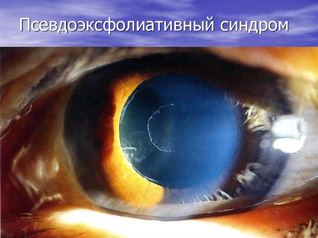 Псевдоэксфолиативный синдром