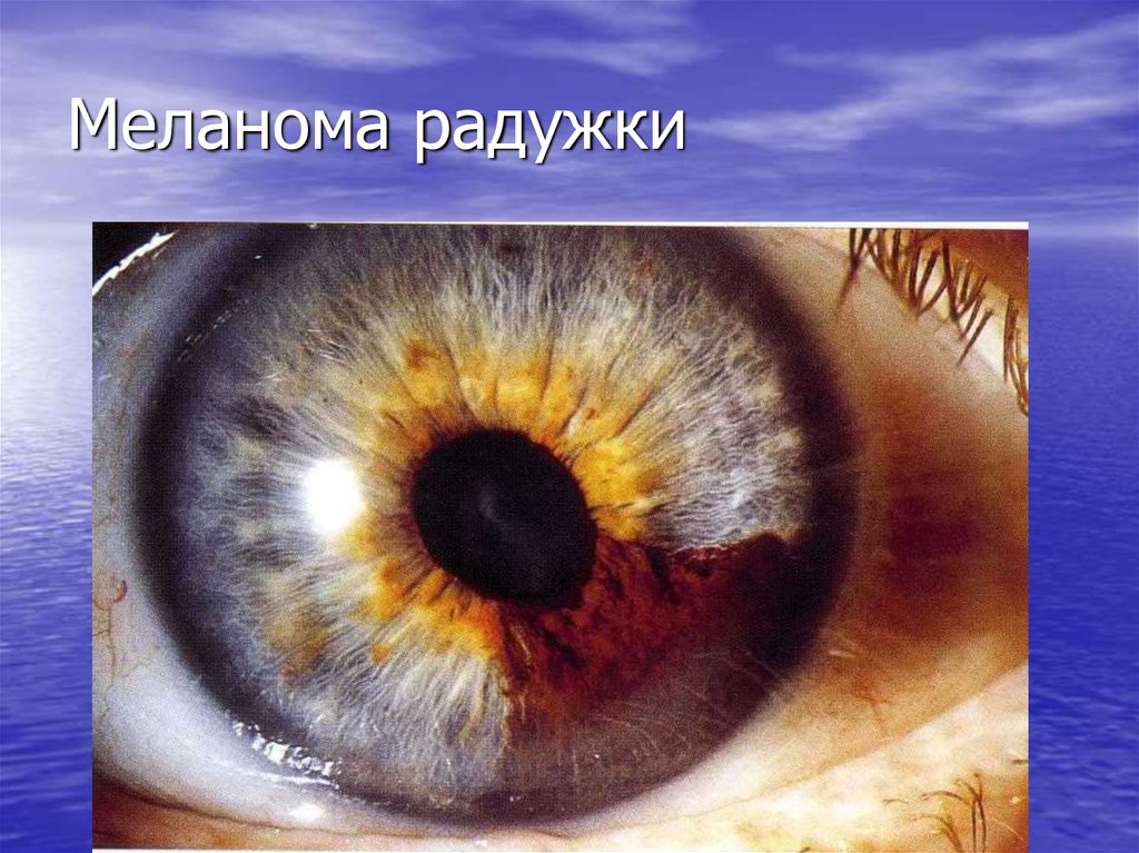 Меланома радужки