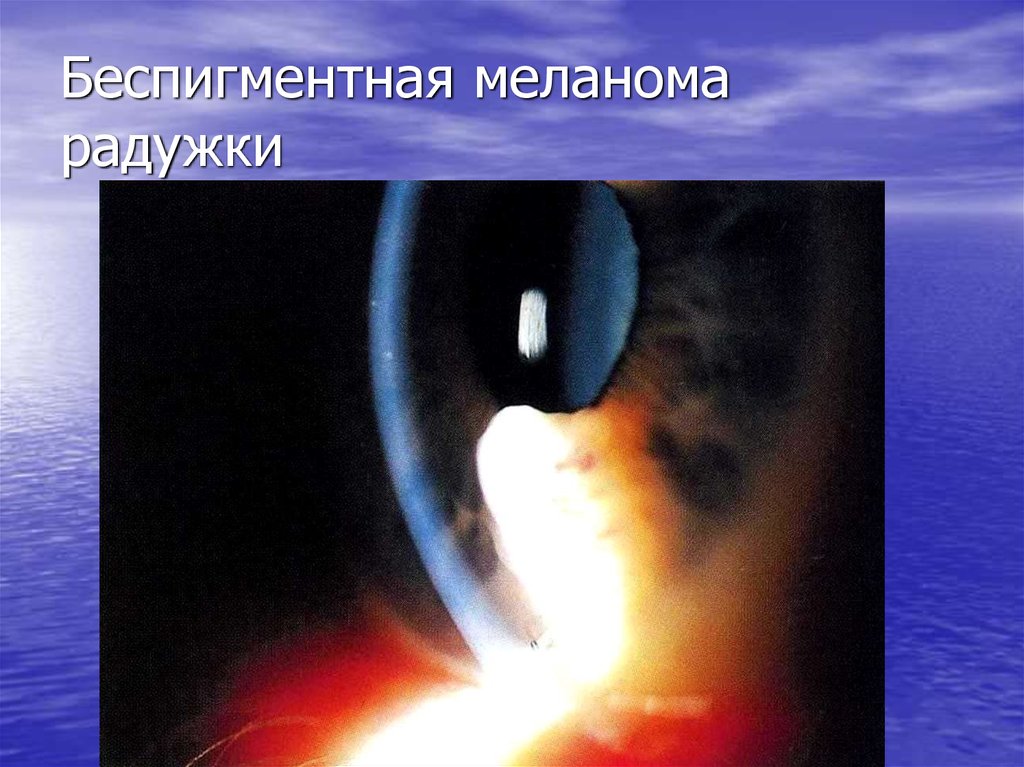 Беспигментная меланома радужки