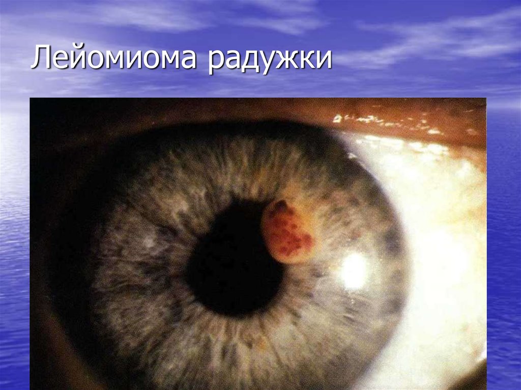 Лейомиома радужки