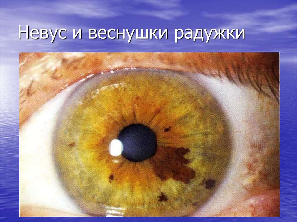 Невус и веснушки радужки