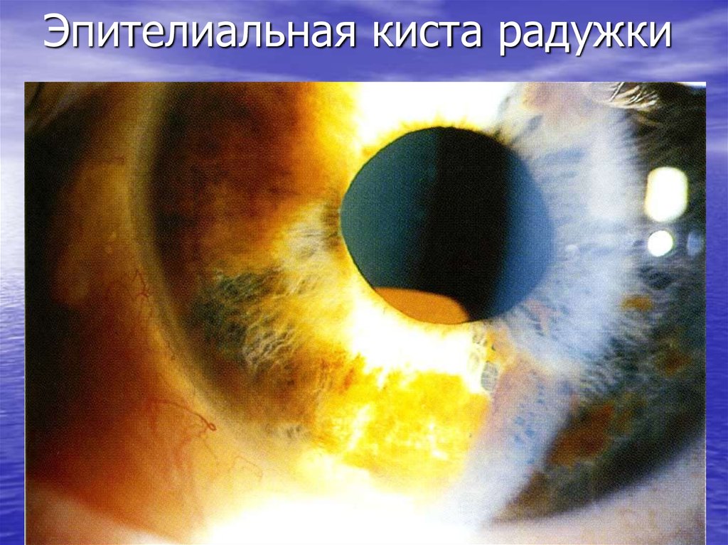 Эпителиальная киста радужки