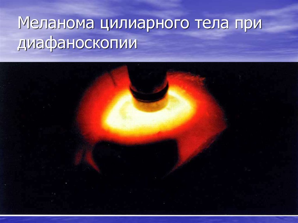 Меланома цилиарного тела при диафаноскопии