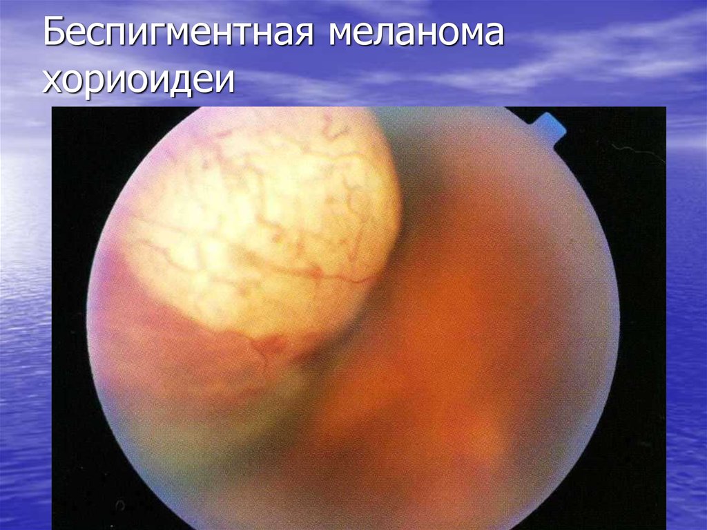 Беспигментная меланома хориоидеи