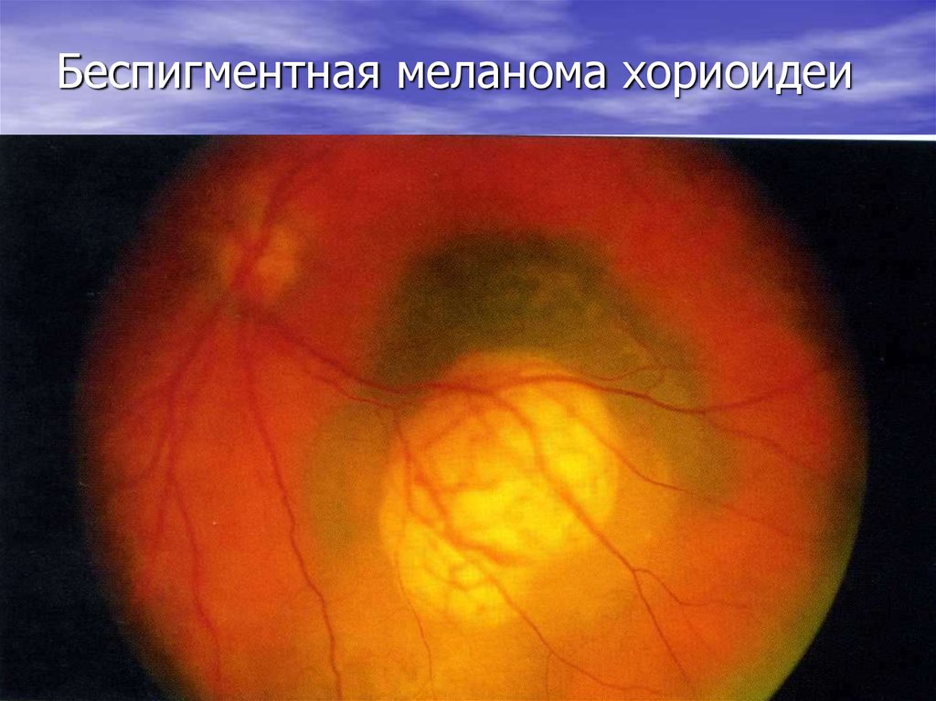 Беспигментная меланома кожи как выглядит Патология сосудистого тракта - презентация онлайн