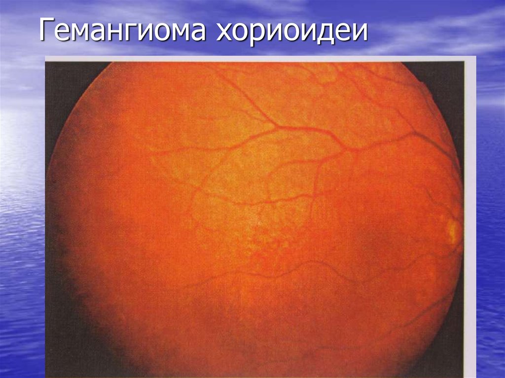 Гемангиома хориоидеи