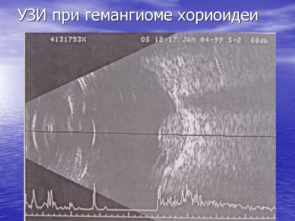 УЗИ при гемангиоме хориоидеи