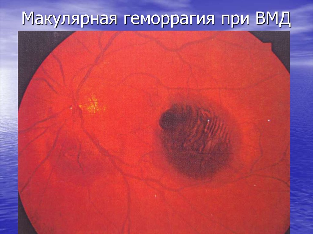 Макулярная геморрагия при ВМД
