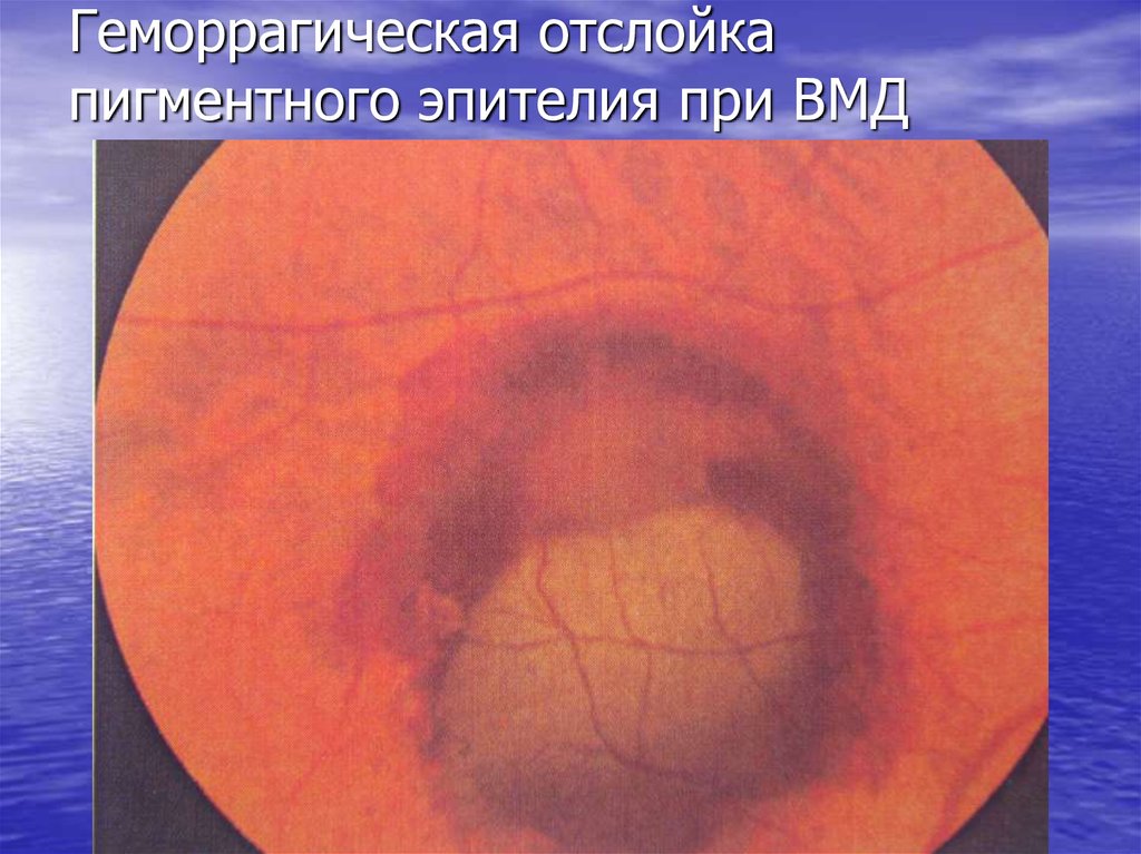 Геморрагическая отслойка пигментного эпителия при ВМД