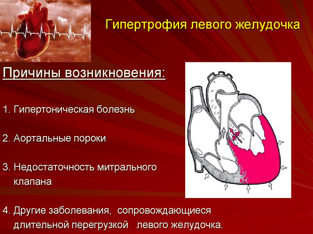 Миокард правого желудочка сердца. Гипертрофия миокарда левого желудочка при гипертонической болезни. Причины развития гипертрофии левого желудочка. Гипертрофия миокарда лж причина. Гипертрофированный миокард левого желудочка причины.