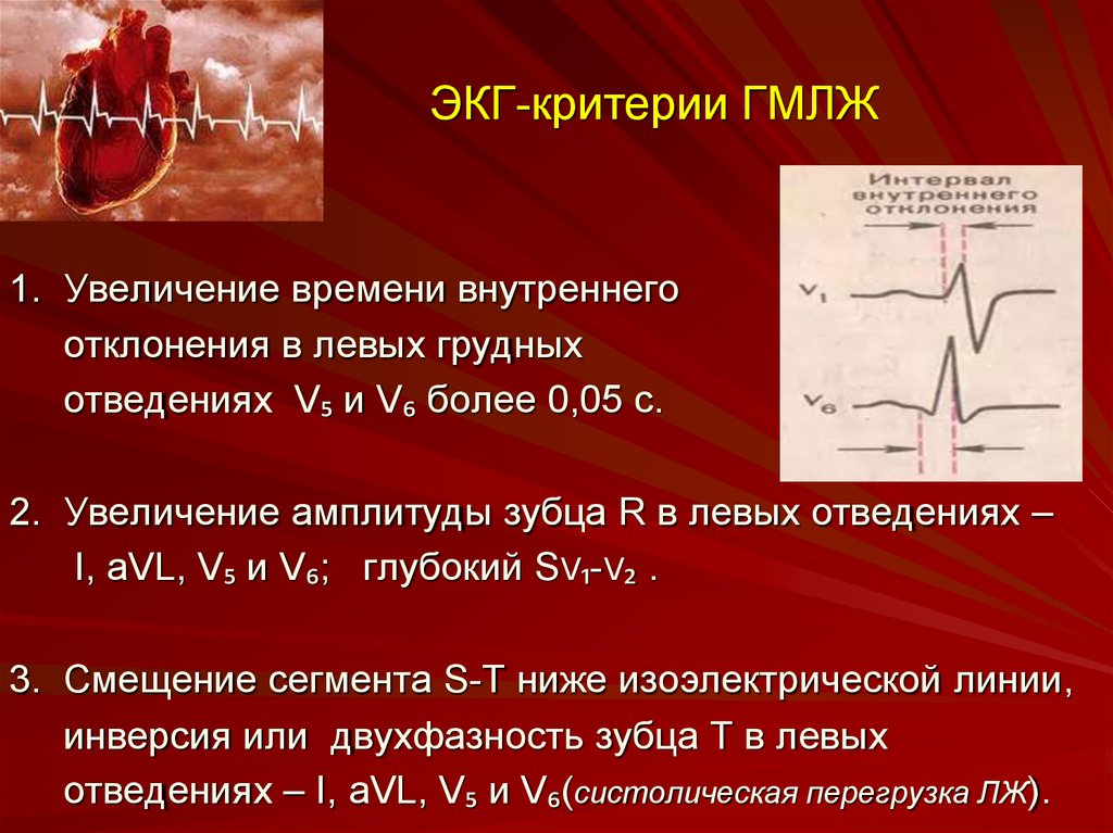 Гипертрофия миокарда левого желудочка. Интервал внутреннего отклонения на ЭКГ. Систолическая перегрузка на ЭКГ. Критерии ЭКГ. Время внутреннего отклонения на ЭКГ.