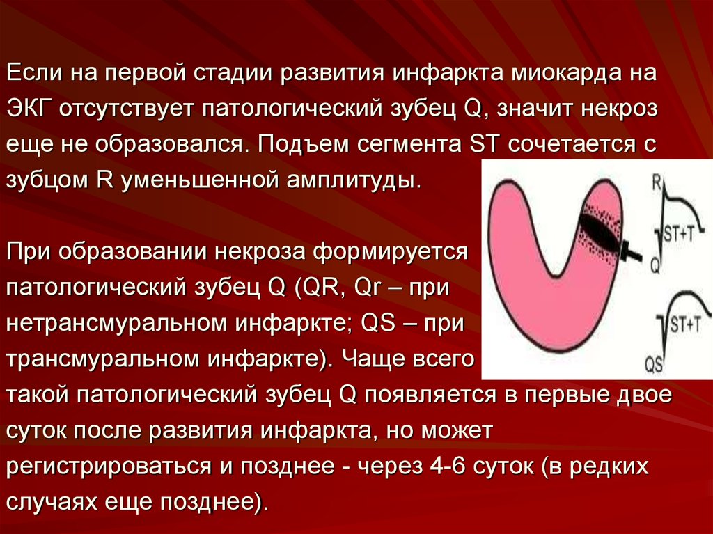 Патологический зубец q при инфаркте. Стадии инфаркта миокарда на ЭКГ. Зубец q при инфаркте миокарда на ЭКГ. Патологический зубец q на ЭКГ. Патологический зубец q на ЭКГ при инфаркте миокарда.