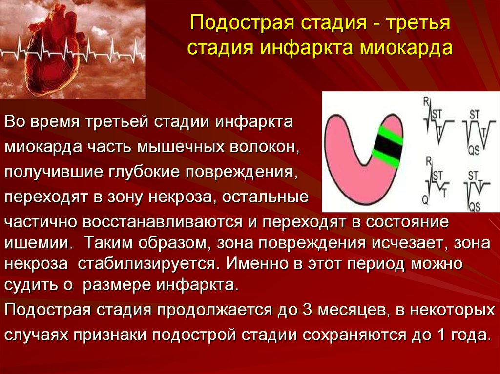 Стадии инфаркта миокарда. Острый инфаркт миокарда подострый период. Подострый период инфаркта миокарда на ЭКГ. Признаком подострой стадии инфаркта миокарда является:. Стадия повреждения инфаркта миокарда.