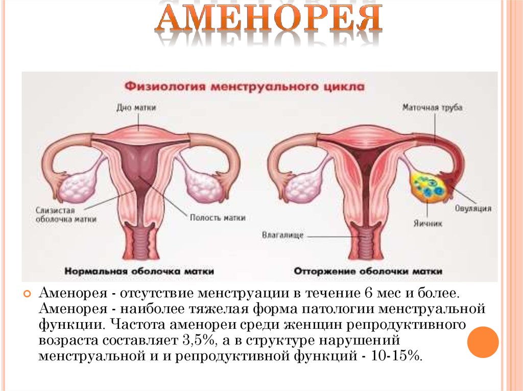 Удаление матки будут ли месячные. Нарушение менструального цикла. Аменорея это отсутствие менструации. Нарушение цикла месячных. Цикл у женщин.