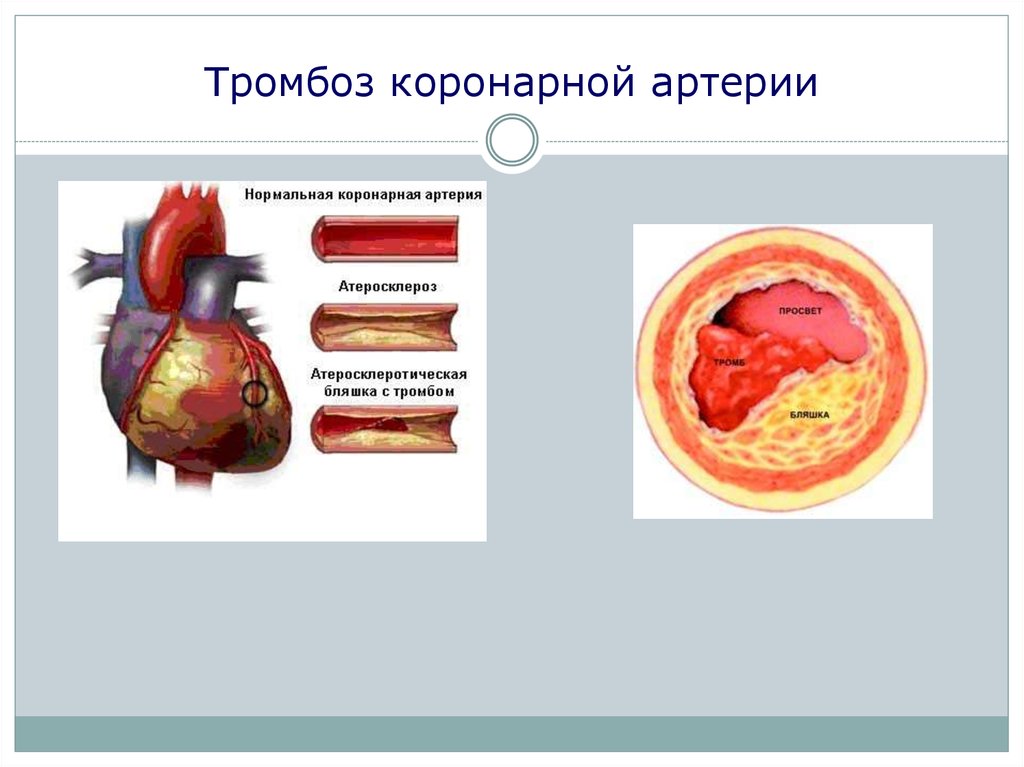 Тромбоз коронарных сосудов