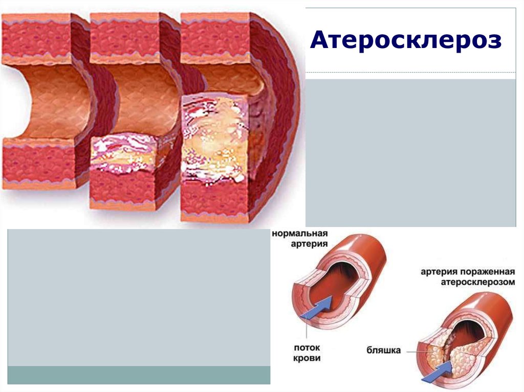 Атеросклероз со. Атеросклеротическая бляшка. Атеросклеротические бляшки в сосудах. Стадии формирования атеросклеротической бляшки.