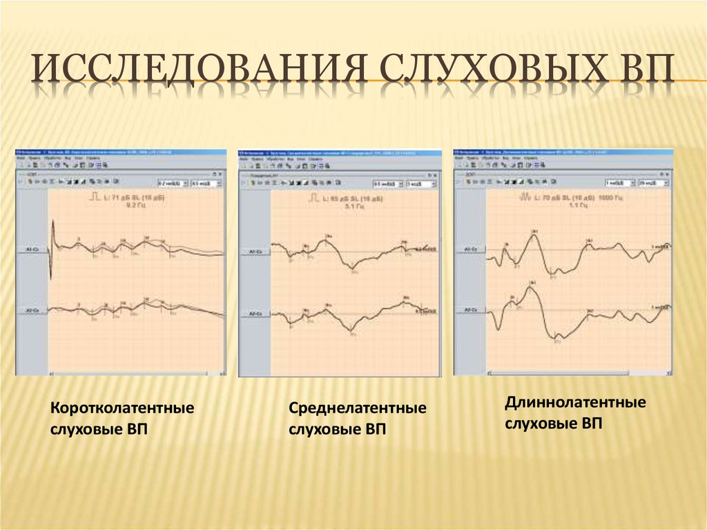 Зрительные вызванные потенциалы