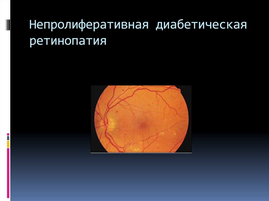 Лечение диабетической ретинопатии. Непролиферативная ретинопатия. Непролиферативная диабетическая ретинопатия. Диабетическая непролиферативная ангиоретинопатия. Непролиферативная ретинопатия,полинейропатия конечностей..