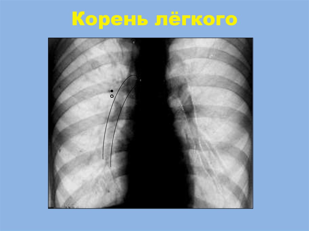 Легко корень. Расширение корня легкого. Расширение корней лёгких на рентгенограмме. Корни легких на рентгене.