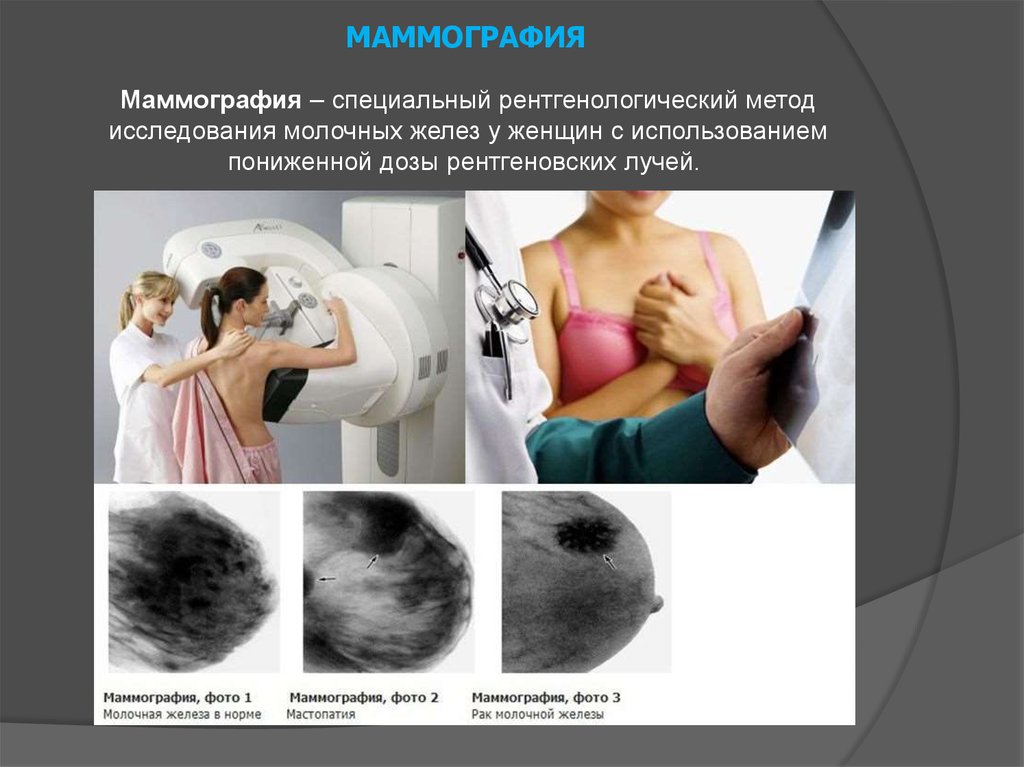 Рак молочной железы жизнь после. Маммография молочной железы м1 м2. Маммография молочных желез РМЖ. Исследование молочный желез. Рик молочной железы маммографич.