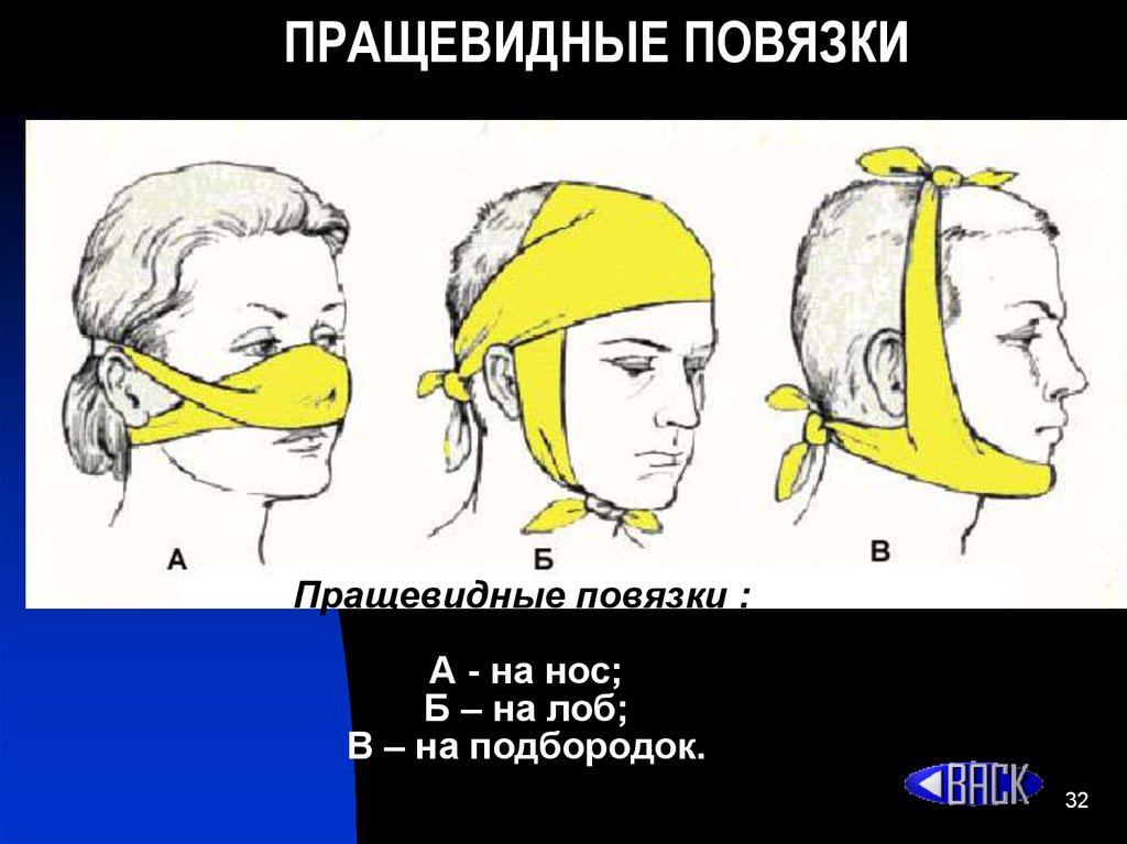 Пращевидная повязка. Перевязка пращевидная. Пращевидная повязка на затылок. Пращевидная повязка на лоб.