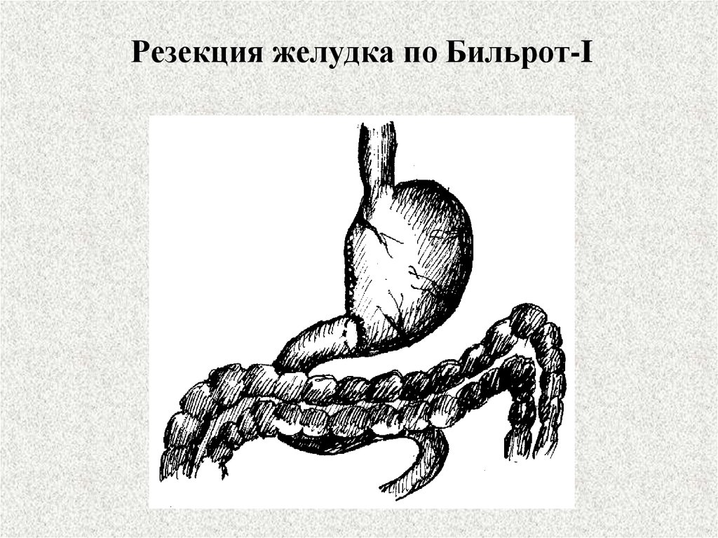 Резекция желудка. Резекция по Бильрот 1 схема. Резекция желудка по типу Бильрот-2. Резекция желудка Бильрот 1 схема. Операция резекции желудка по способу Бильрот 1.