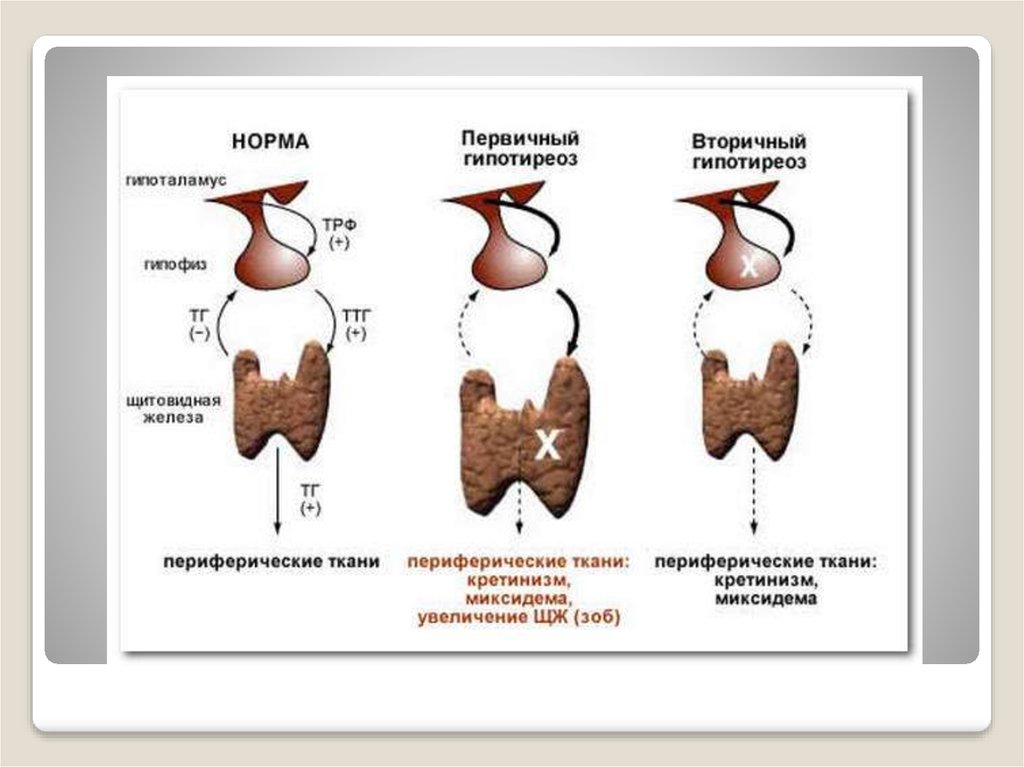 Гипотиреоз патофизиология презентация