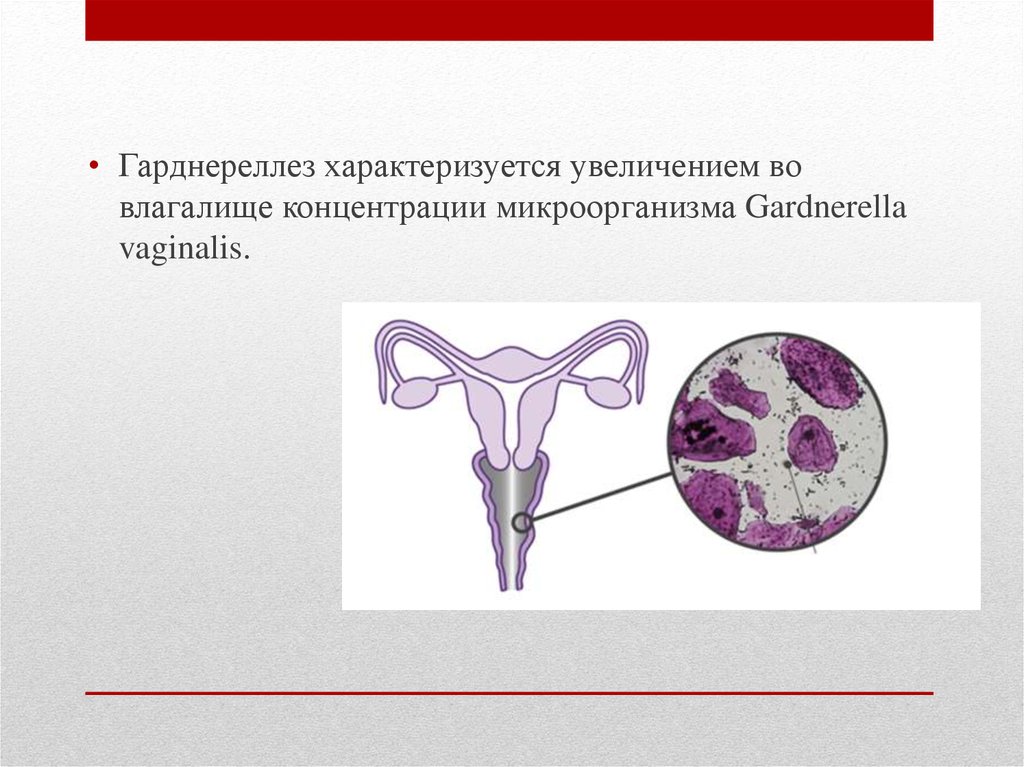 Гарднереллез у женщин. Гарднерелла выделения. Гарднерелла во влагалище. Гарднереллез презентация. Гарднерелла выделения влагалища.