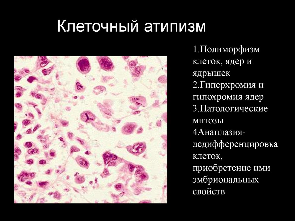 Клетки с гиперхромными ядрами. Клеточный полиморфизм. Полиморфизм клеток в онкологии. Полиморфизм и атипия клеток.