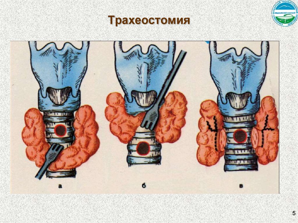 Загрудинная трахеостомия. Трахеотомия и трахеостомия. Верхняя трахеостомия техника выполнения. Нижняя трахеостомия топографическая анатомия.