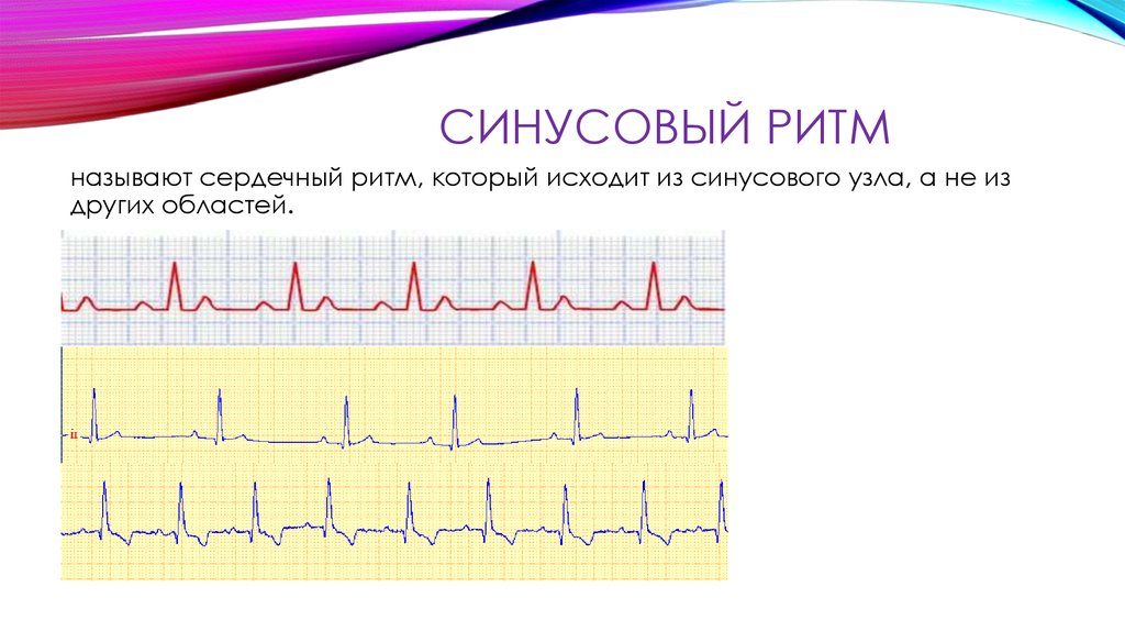 Ритмом называется. Норма ЭКГ синусный ритм. Синусовый ритм на ЭКГ норма. Синусовый ритм сердца норма. Синусовый и несинусовый ритм ЭКГ.