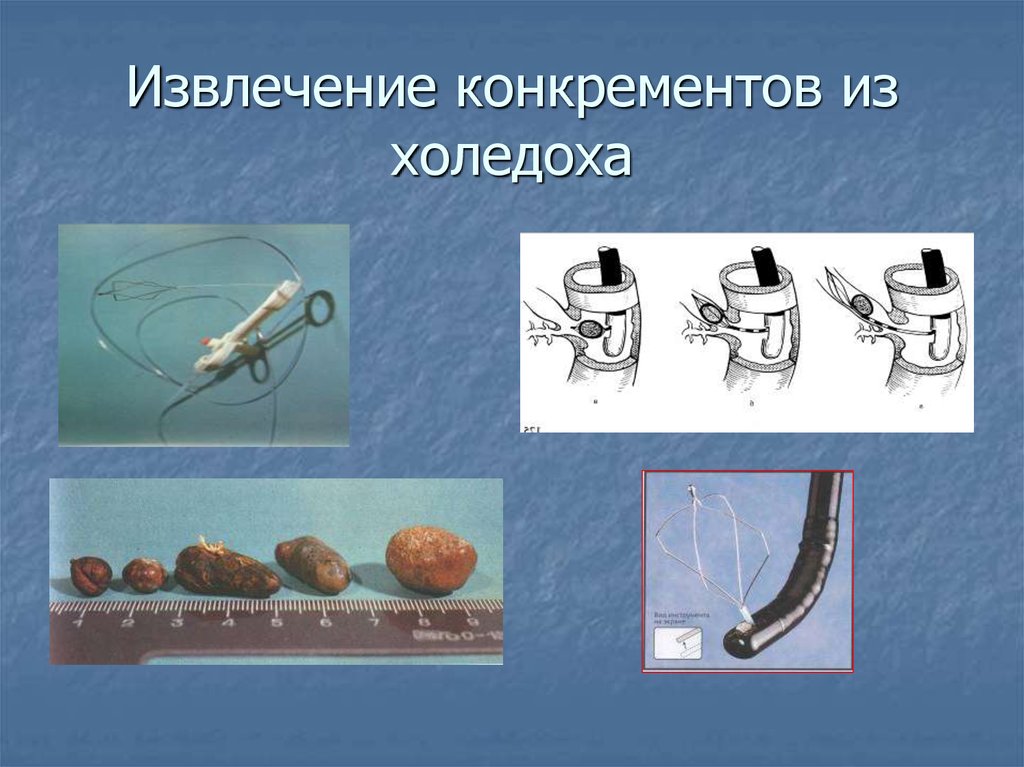 Извлечение. Извлечение конкрементов из холедоха. Резидуальные камни холедоха. Эндоскопическая удаление камней из холедоха. Буж для холедоха применение.