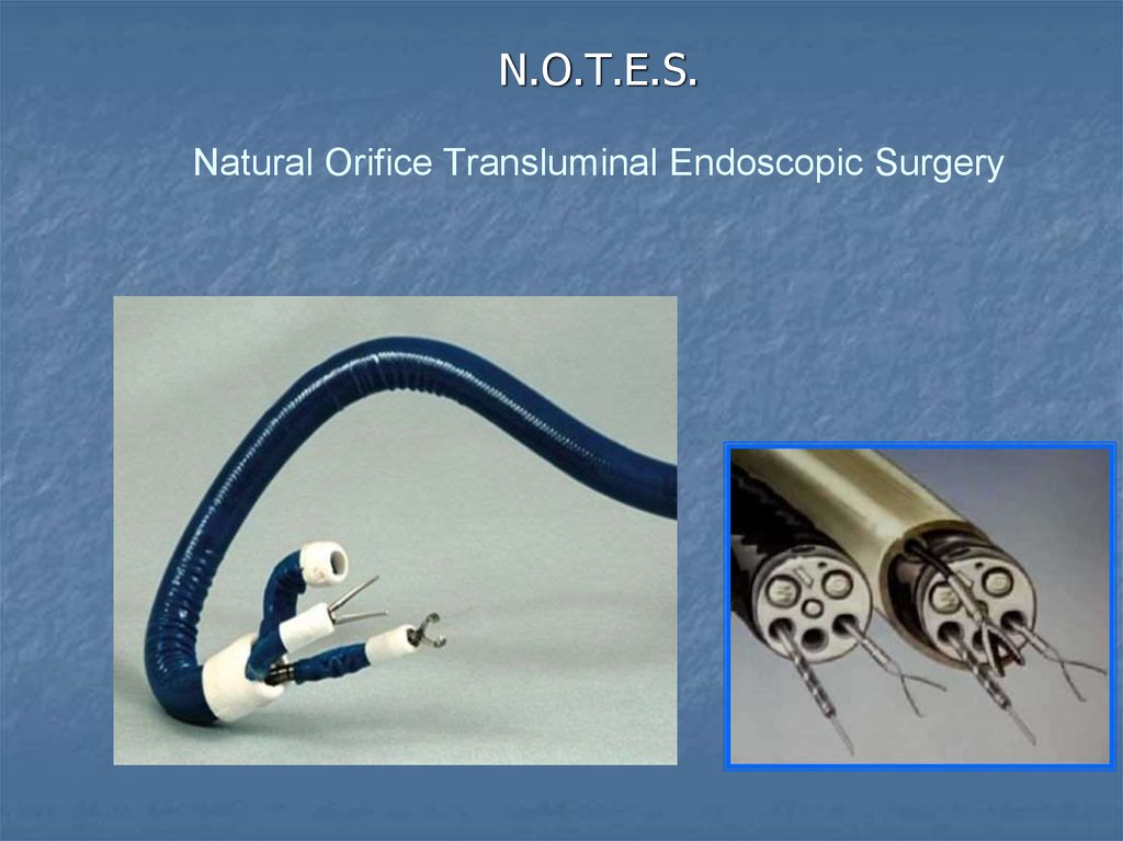 N.O.T.E.S. Natural Orifice Transluminal Endoscopic Surgery