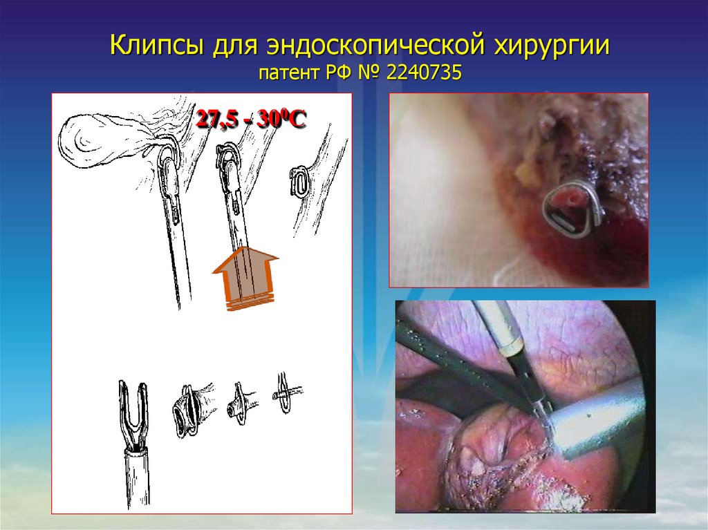Клипсы для эндоскопической хирургии патент РФ № 2240735