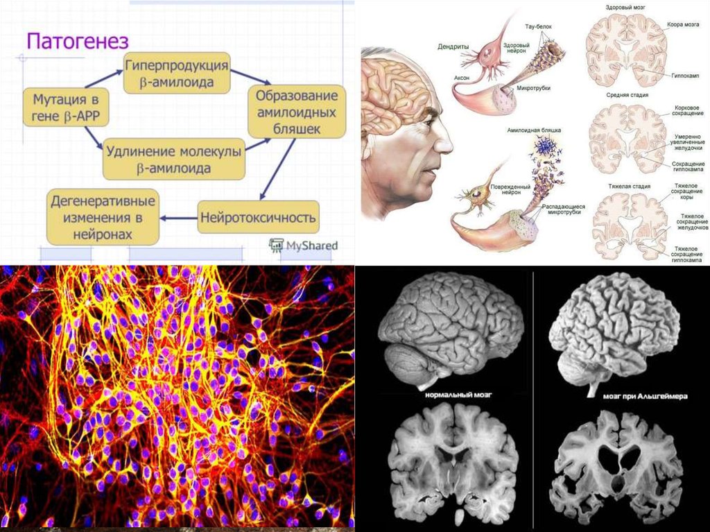 Возрастные изменения мозга. Механизм развития болезни Альцгеймера. Болезнь Альцгеймера патологическая анатомия. Патогенез Альцгеймера. Презентация на тему болезнь Альцгеймера.