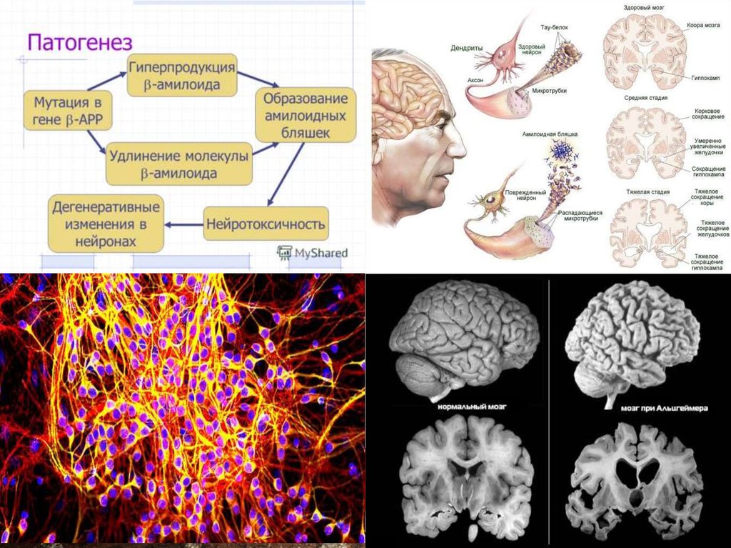 Нейродегенеративные заболевания мозга. Механизм развития болезни Альцгеймера. Болезнь Альцгеймера патологическая анатомия. Патогенез Альцгеймера. Презентация на тему болезнь Альцгеймера.