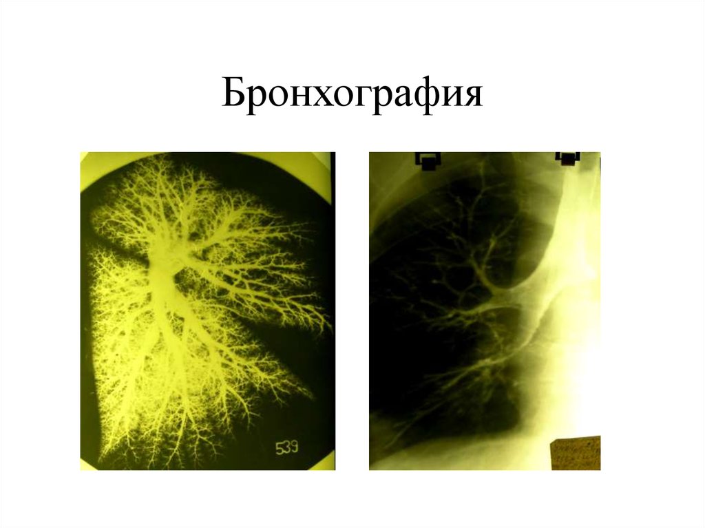 Бронхография. Селективная бронхография. Бронхография контрастное вещество. Бронхография это метод.
