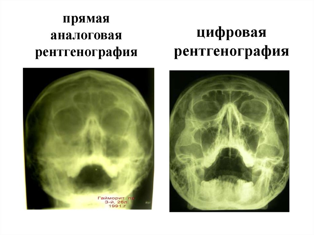 Отличается рентген. Аналоговая и цифровая рентгенография. Аналоговый и цифровой рентгеновский снимок. Цифровая рентгенография. Цифровые снимки рентгена.