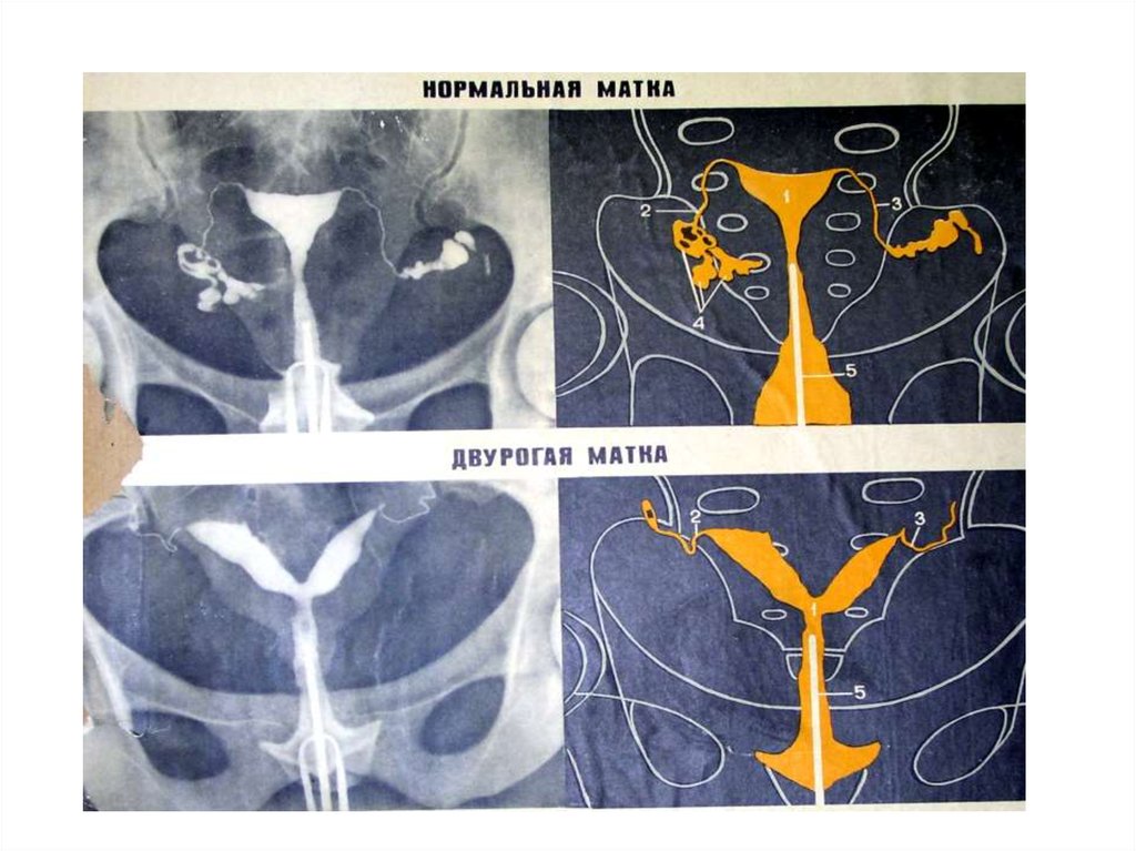 Что такое двурогая матка. Рентгеноанатомия матки и труб.