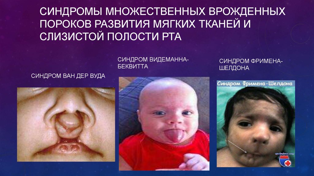 СИНДРОМЫ МНОЖЕСТВЕННЫХ ВРОЖДЕННЫХ ПОРОКОВ РАЗВИТИЯ МЯГКИХ ТКАНЕЙ И СЛИЗИСТОЙ ПОЛОСТИ РТА