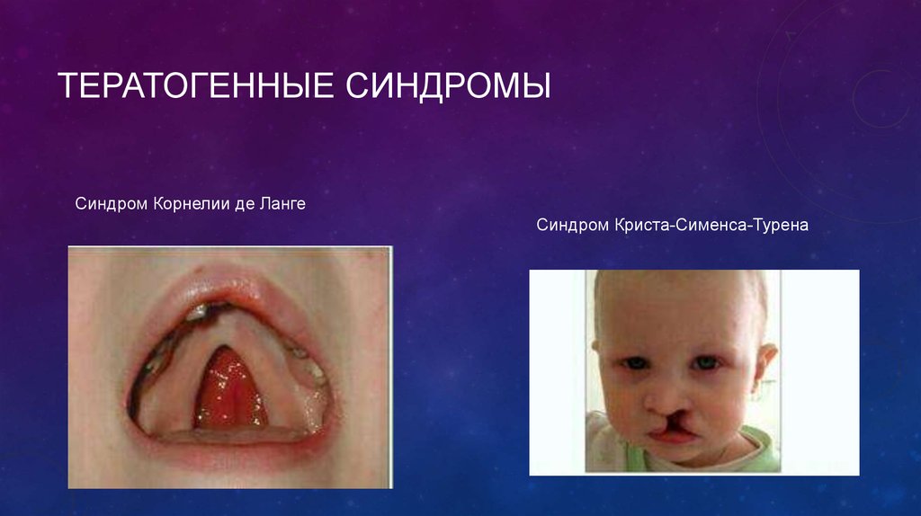 ТЕРАТОГЕННЫЕ СИНДРОМЫ