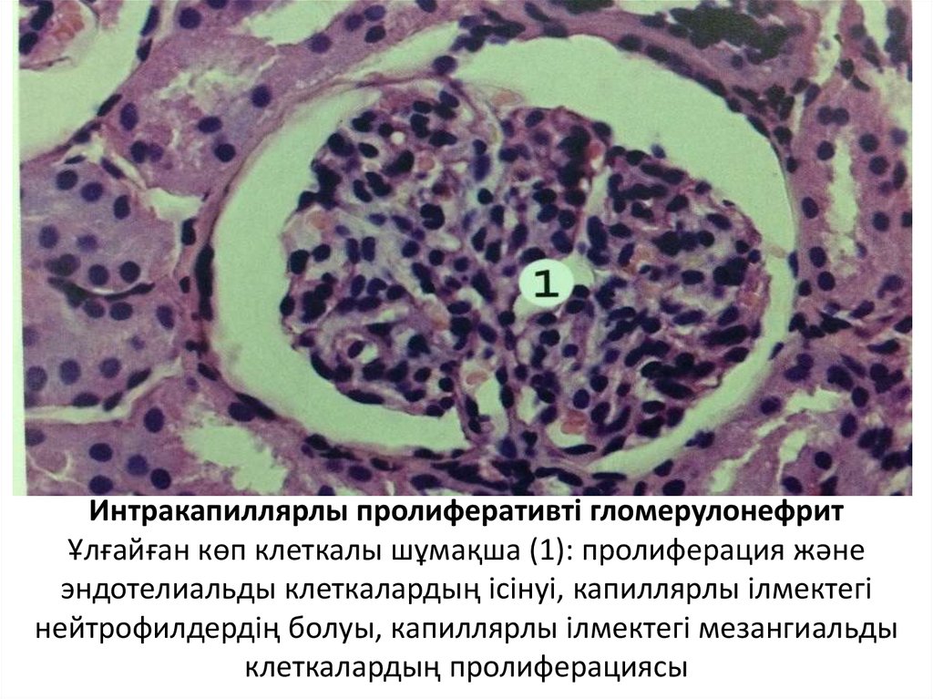 Интракапиллярлы пролиферативті гломерулонефрит Ұлғайған көп клеткалы шұмақша (1): пролиферация және эндотелиальды клеткалардың