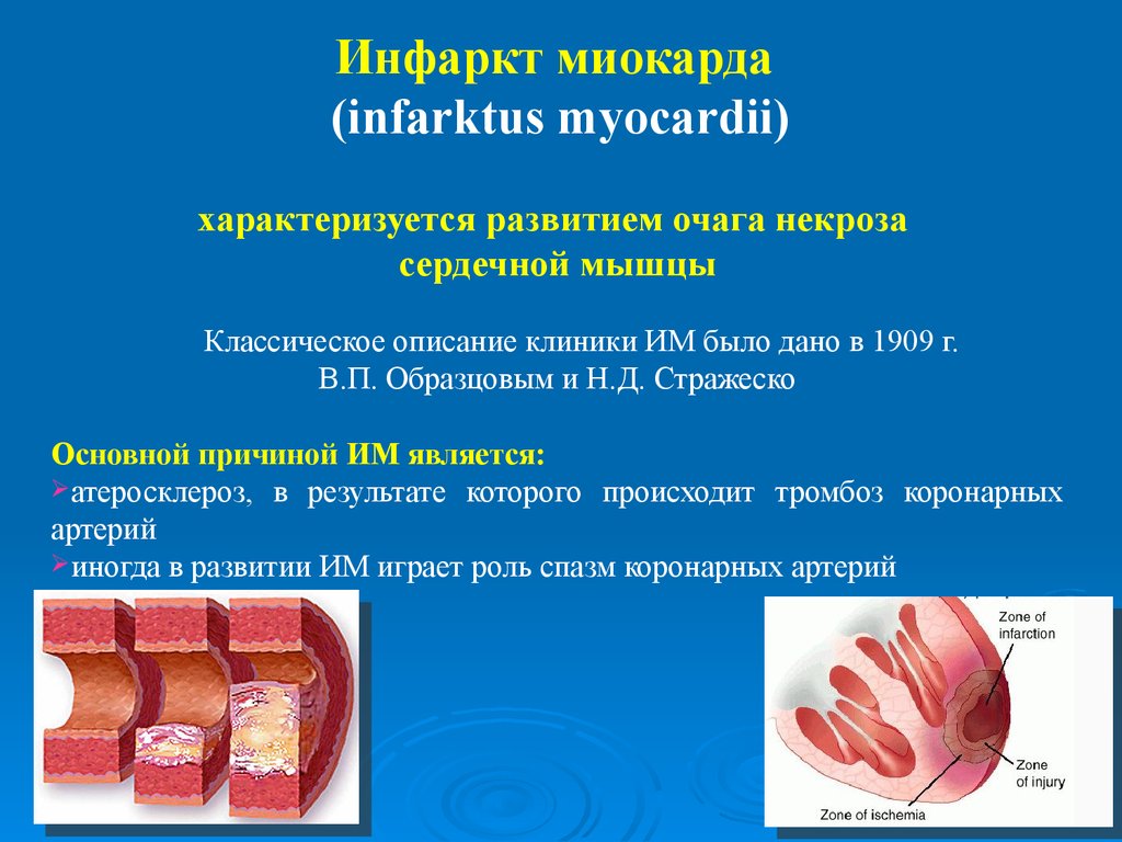 Гипертензивная болезнь сердца с преимущественным