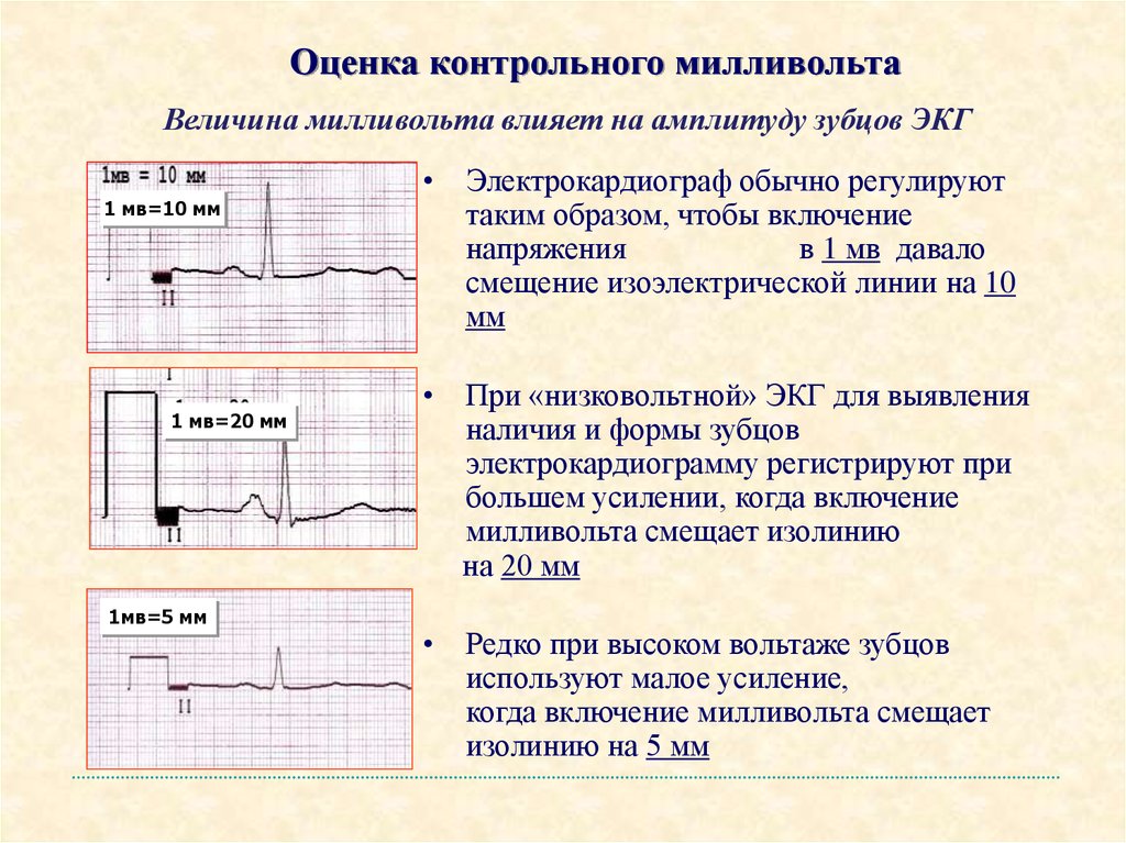 Вольтаж экг