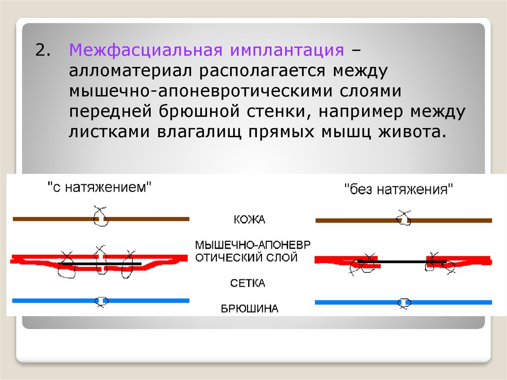 Располагающаяся между. Лапаротомия через влагалище прямой мышцы. Межфасциальные щели на животе. Межфасциальные поезда.