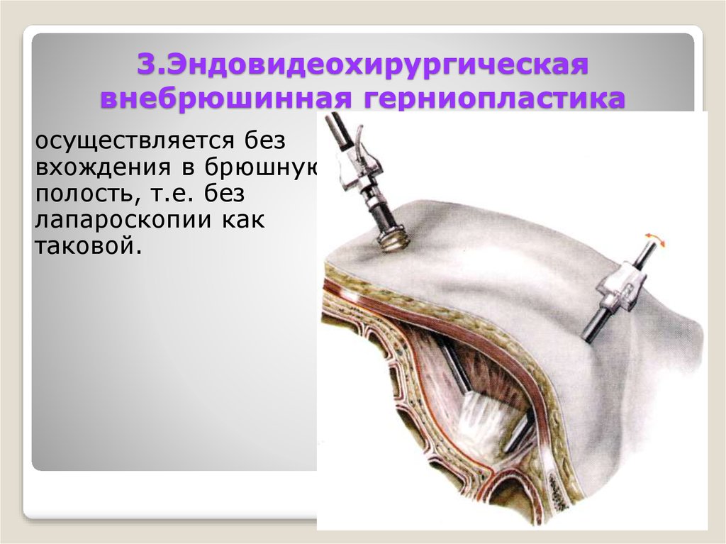 3.Эндовидеохирургическая внебрюшинная герниопластика